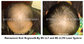 300 Watts Clinic Laser Treatment For Hair Loss , Low Level Laser Therapy Hair Loss Painless supplier