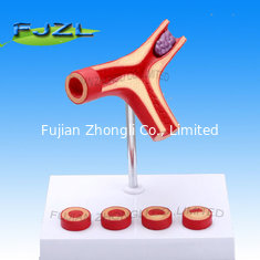 China Arteriosclerosis Model with Thrombus supplier