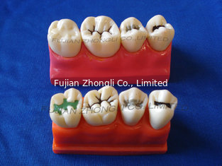 China Dental Four times the pit and fissure model supplier
