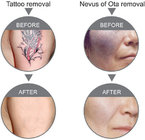 Medical ND YAG Laser Q Switch Tattoo Removal Machine for Birthmark