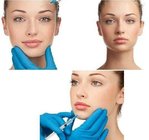 Hyaluronic Acid injectable Dermal Filler for remove wrinkles/Nasolabial fold/Smile lines/Worry lines/Crow/s feet